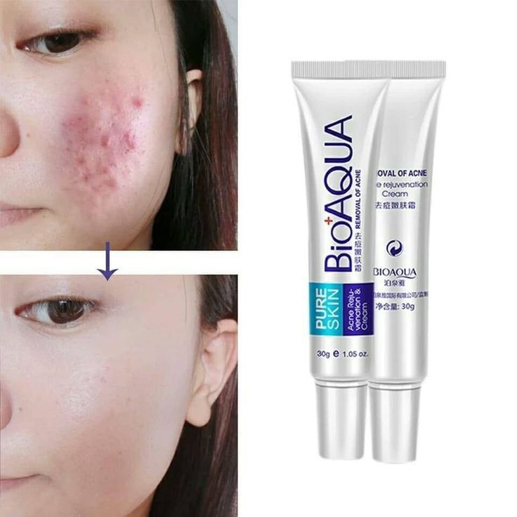 BioAqua Acne & Scar Removal Cream – 30g