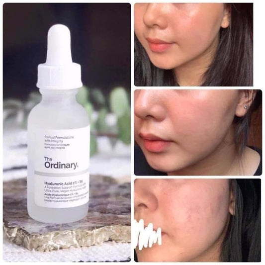 The Ordinary Niacinamide 10% + Zinc 1% Serum – Oil Control & Blemish Treatment (30ml)